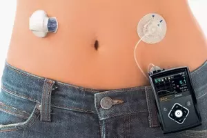 Insulin Pumps: A Comprehensive Guide to Understanding Continuous Insulin Delivery Systems